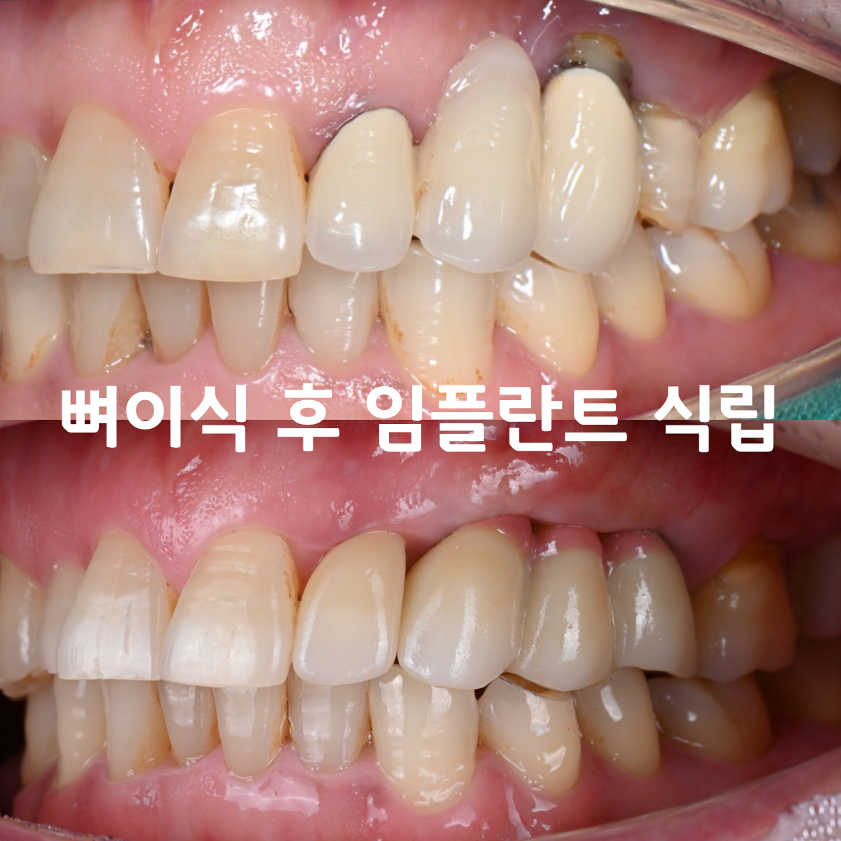 [치료사례]  오래된 앞니 브릿지 아래 치아뿌리가 썩었을 때, 임플란트로 다시 웃을 수 있을까요?