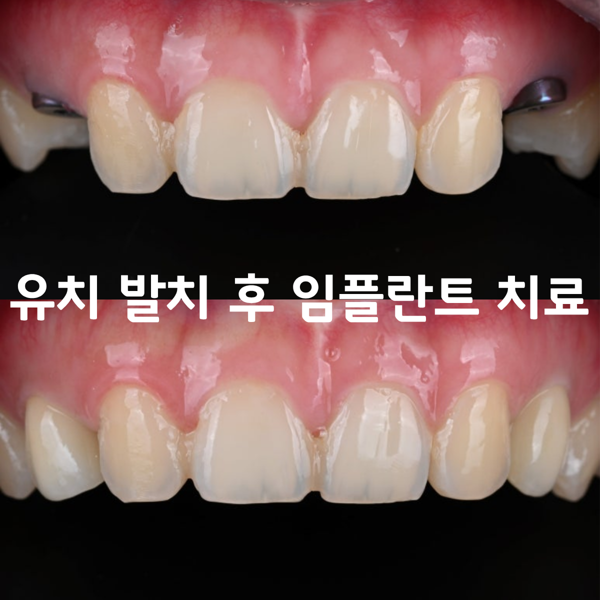 [치료사례] 오래된 유치 송곳니가 흔들린다면? 앞니 스트라우만 임플란트로 해결한 실제 케이스