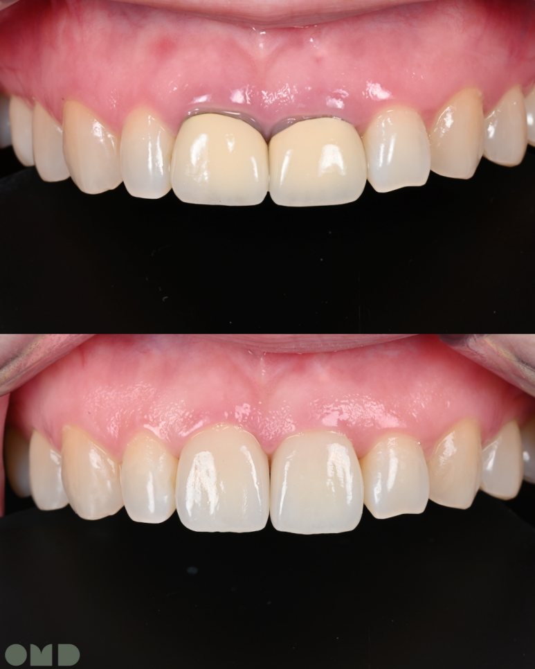 BOPT 컨셉을 이용한 앞니 크라운 치료 케이스