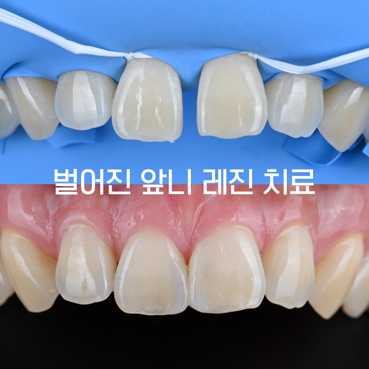[치료사례] 앞니 사이 벌어짐 자연치아를 깎지 않고 해결한 방법 - 부천시청역치과 앞니 레진 수복 케이스