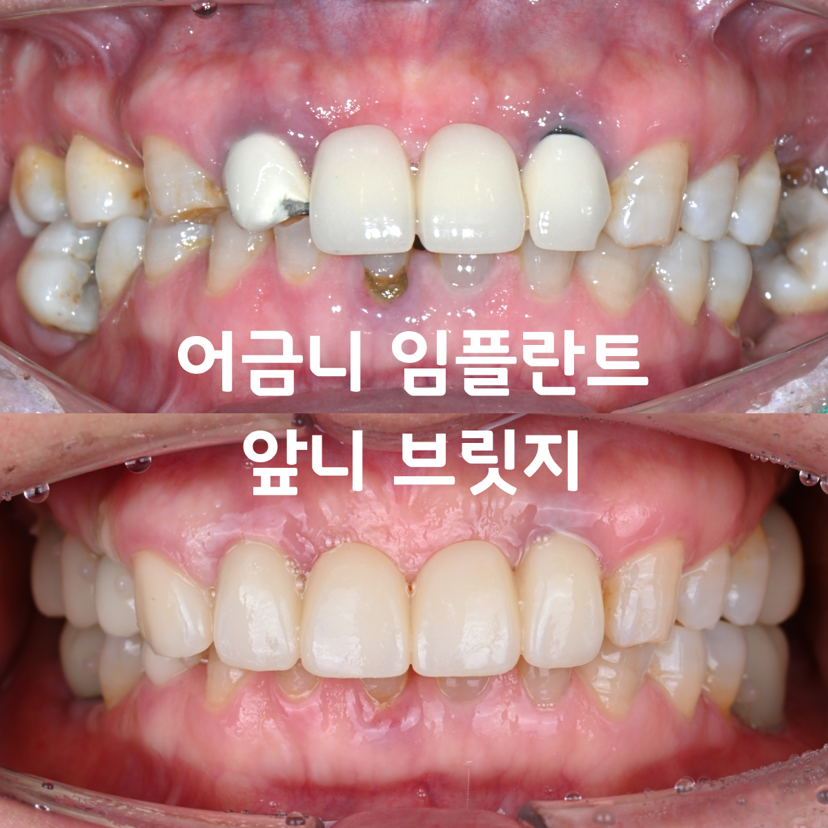 [치료사례]  치주염으로 어금니를 모두 잃었을 때, 다시 제대로 씹을 수 있을까요?