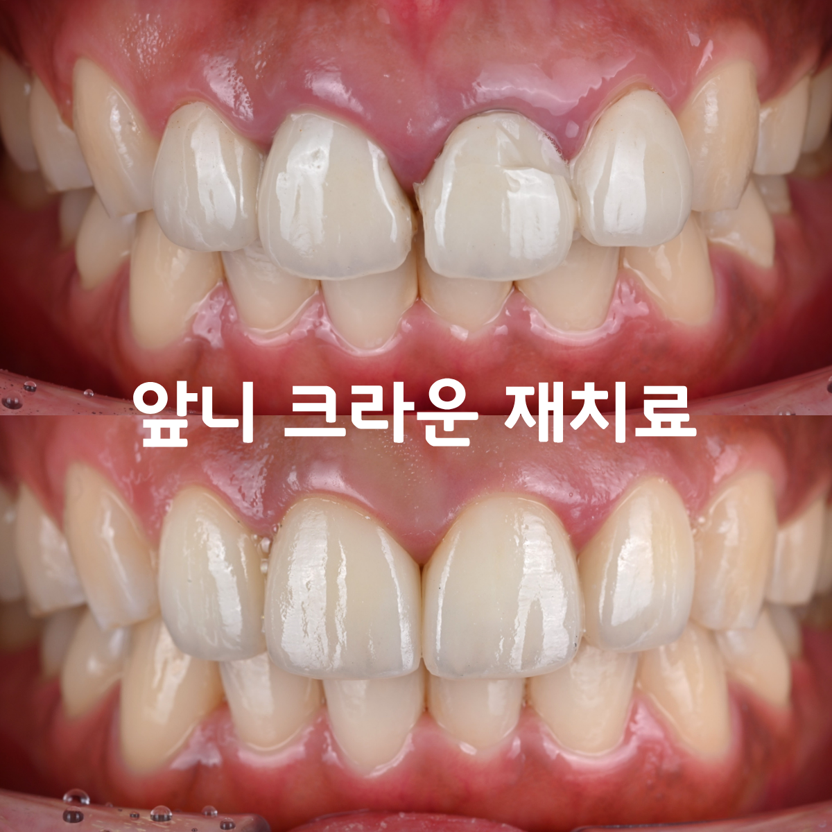 오래된 앞니 크라운이 깨졌는데 어떻게 해야하나요...?