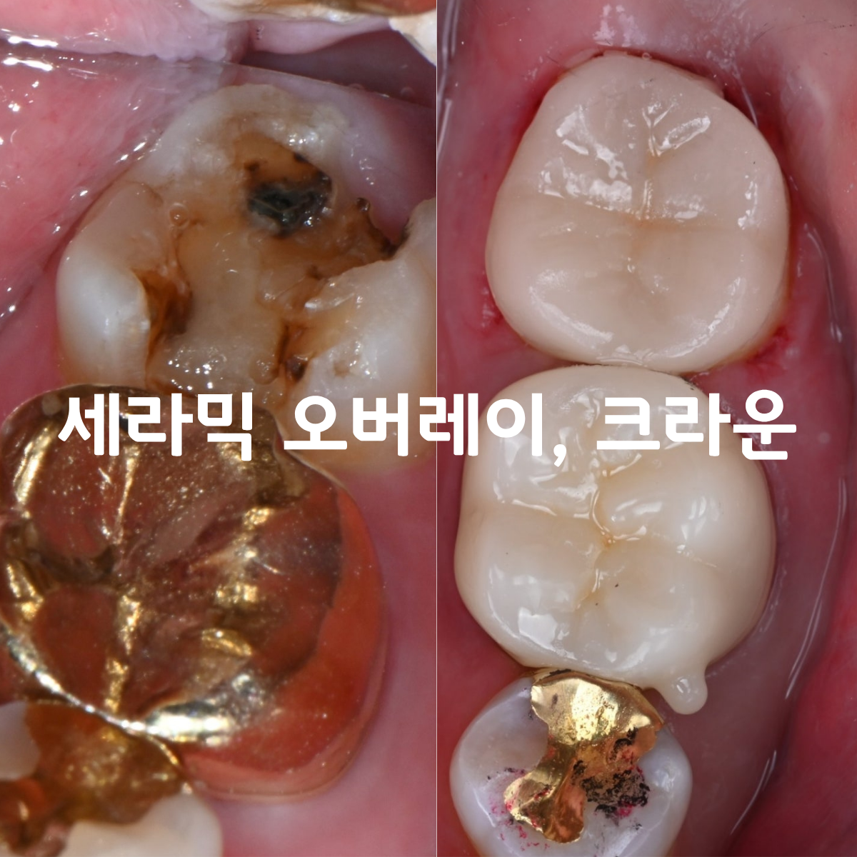 [치료사례] 오래된 금니(골드 인레이)가 빠졌을 때, 꼭 크라운을 씌워야 할까요?