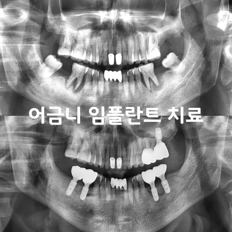 [치료사례] 치주염으로 어금니 여러개를 잃었을 때, 임플란트로 치료하면 다시 씹을 수 있을까요?