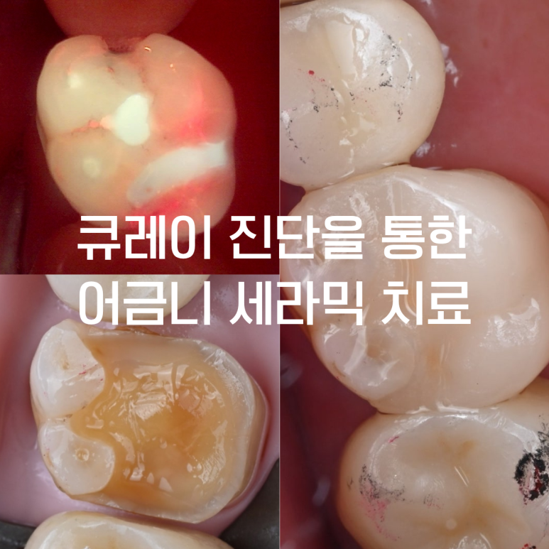 어금니 파절과 숨은 크랙(치아 균열): 큐레이(Q-ray) 조기 진단과 세라믹 온레이를 통한 자연치아 보존