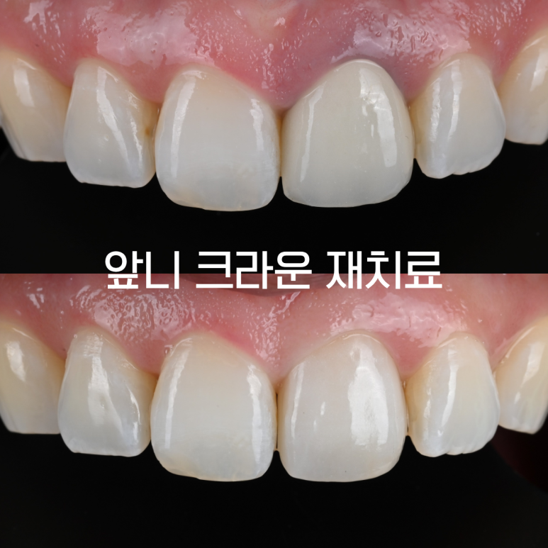 [치료사례] 앞니 크라운 변색, 잇몸이 까맣게 변했다면? 앞니 크라운 재치료 사례