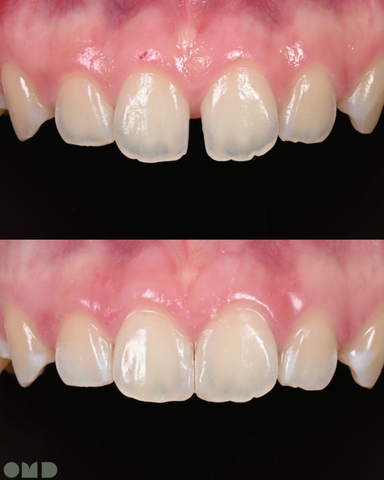 벌어진 앞니. 부천 라미네이트 대신 레진으로 3일만에 치료한 케이스.