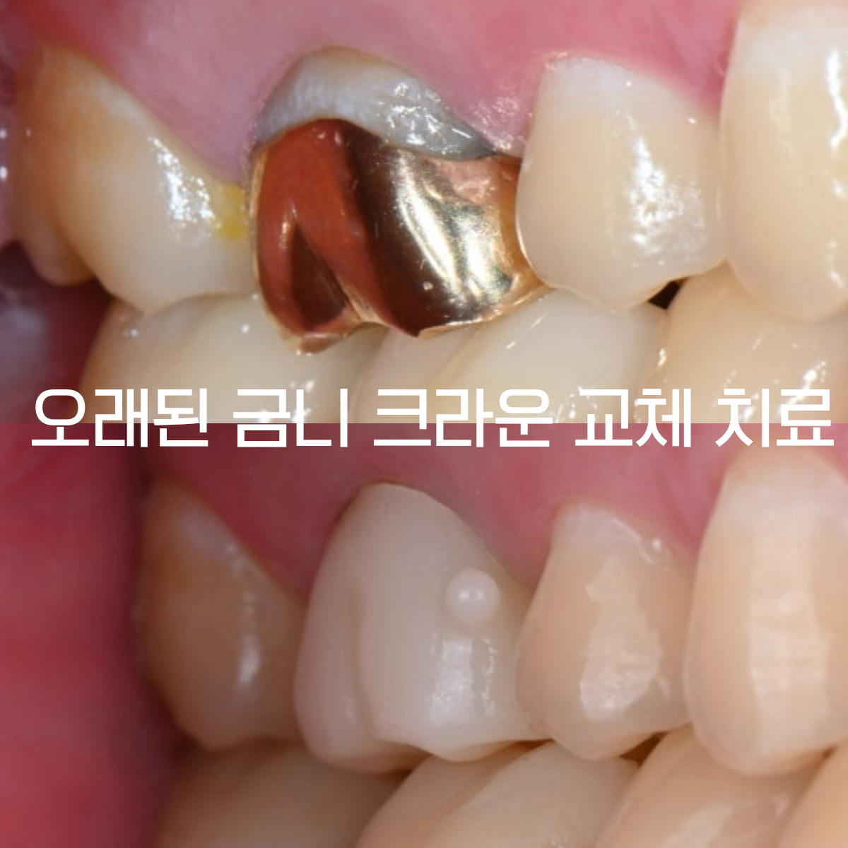 [치료사례] 오래된 금니가 욱신거리고 안쪽에 충치가 생겼다면? 같은 문제가 반복되지 않도록 하는 크라운 재치료