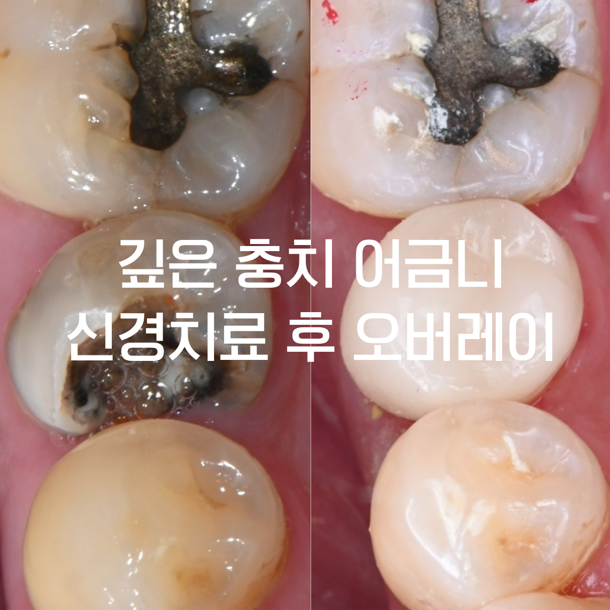 [치료사례] 어금니 충치가 심해 발치를 권유받았다면? 자연치아를 살린 세라믹 오버레이 치료 사례. 부천시청역치과.
