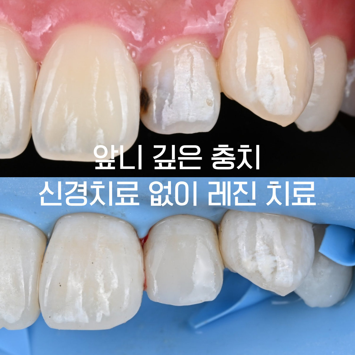 앞니 사이 충치, 신경 가까이 진행됐어도 레진으로 치료할 수 있을까? | 부천 중동 이보다치과