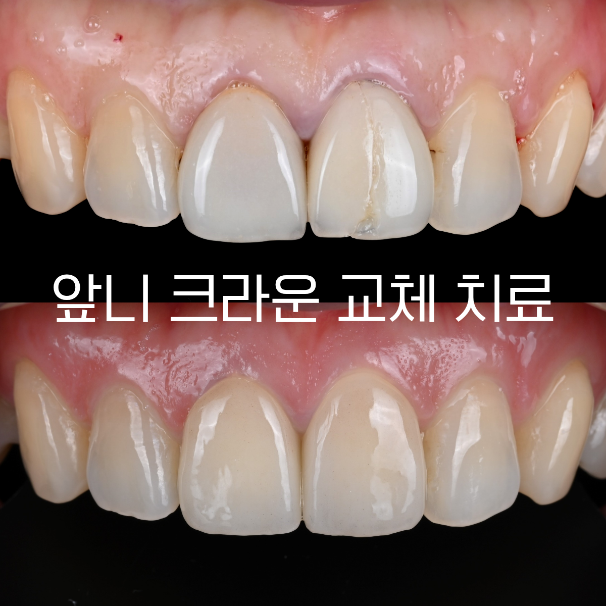 [치료사례] 앞니 크라운이 깨지고 색이 안 맞을 때, 단순 교체가 아닌 단계별 정밀 치료가 필요한 이유