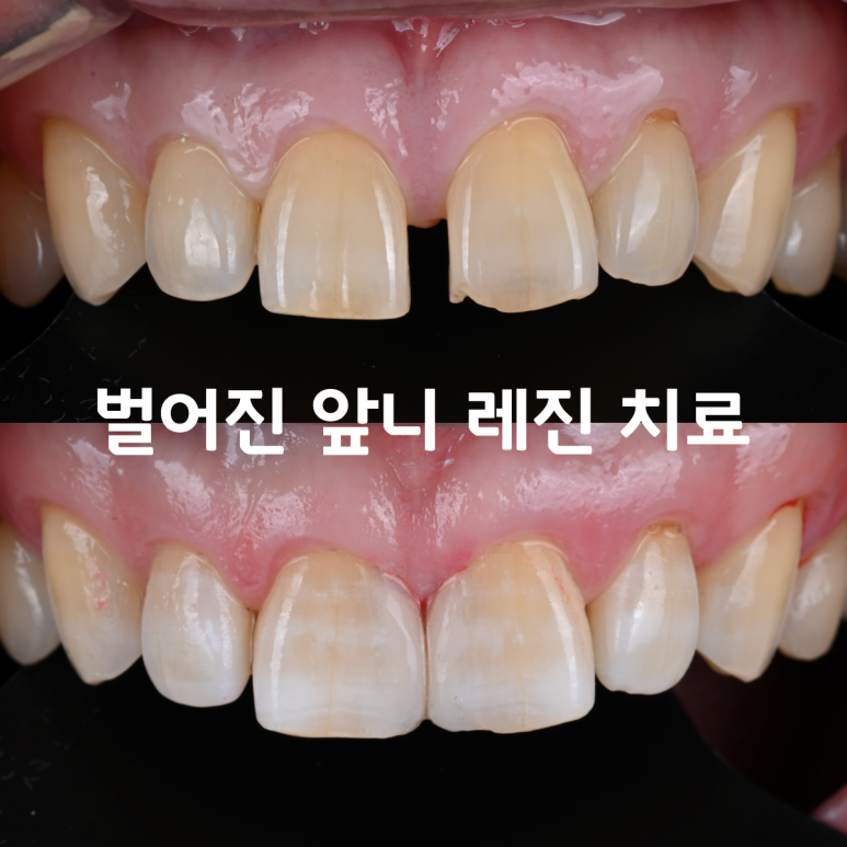 [치료사례] 앞니 사이가 벌어졌을 때, 빠르게 해결할 수 있는 방법이 있을까요?